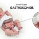 Gastroshiza: Causes, Symptoms, and Treatment Options
